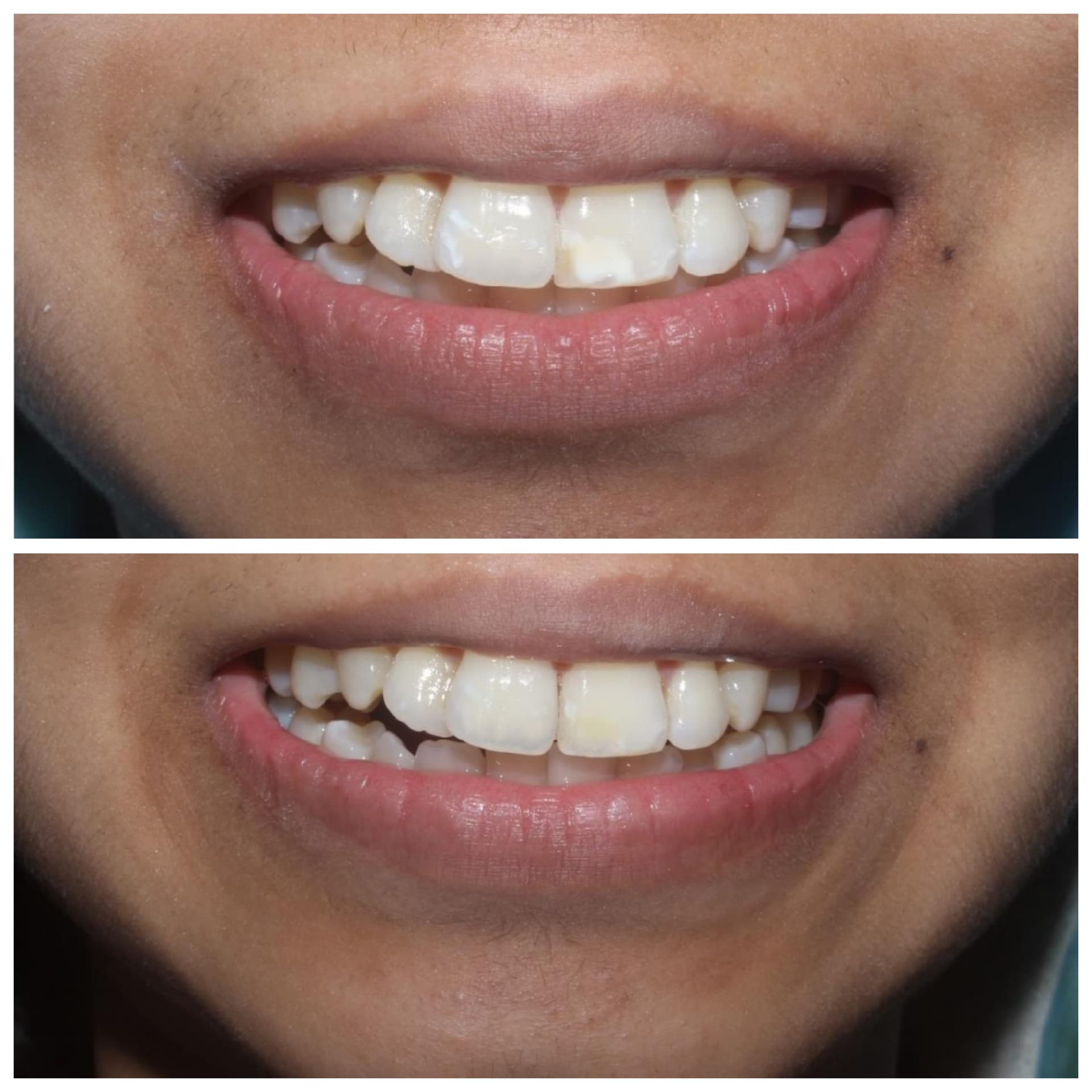 Dental restoration - Before and After