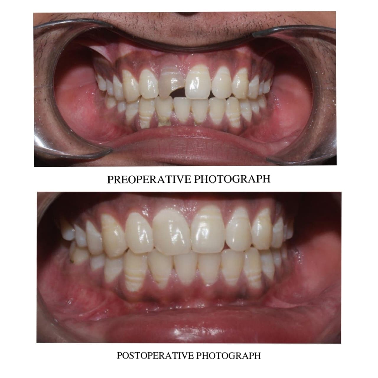 Discoloured tooth treatment Belapur before and after — a single dark front tooth lightened with non-vital bleaching