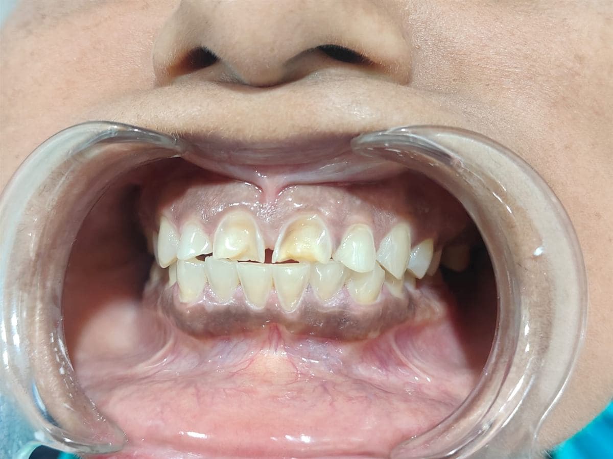 Tooth erosion treatment Belapur before photo: front teeth worn and hollowed out by acidity and aerated drinks