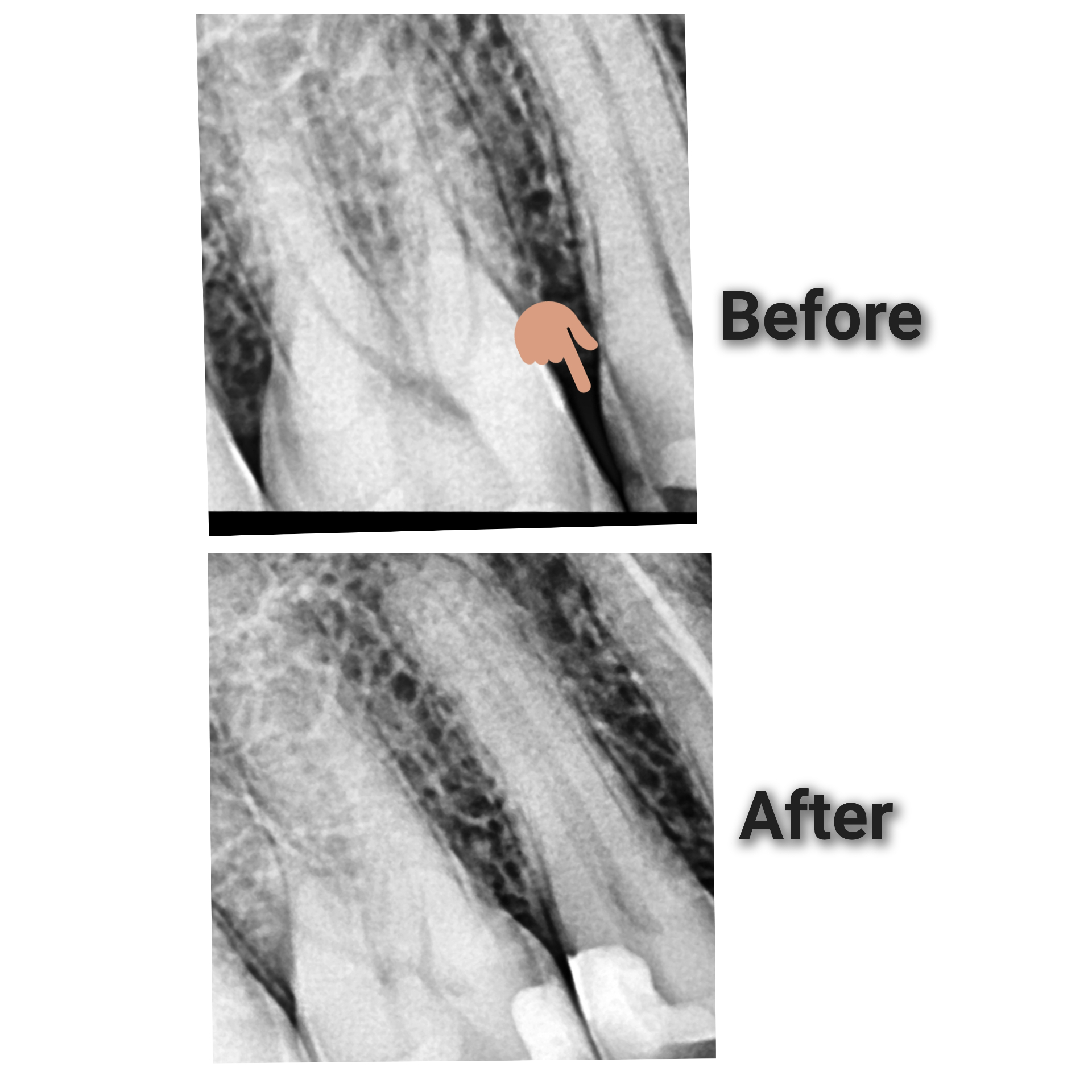 Root canal treatment - Before and After