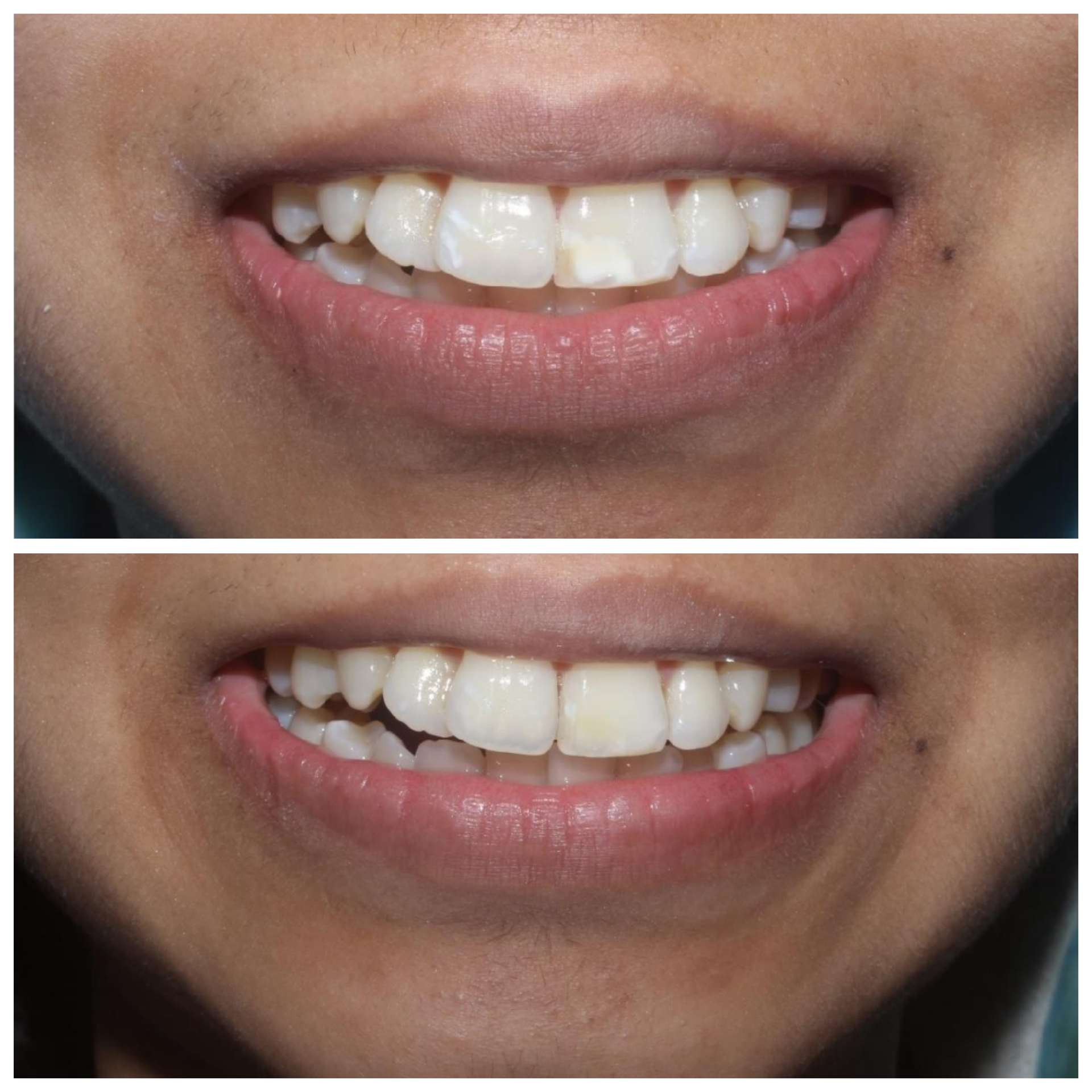 Dental restoration - Before and After