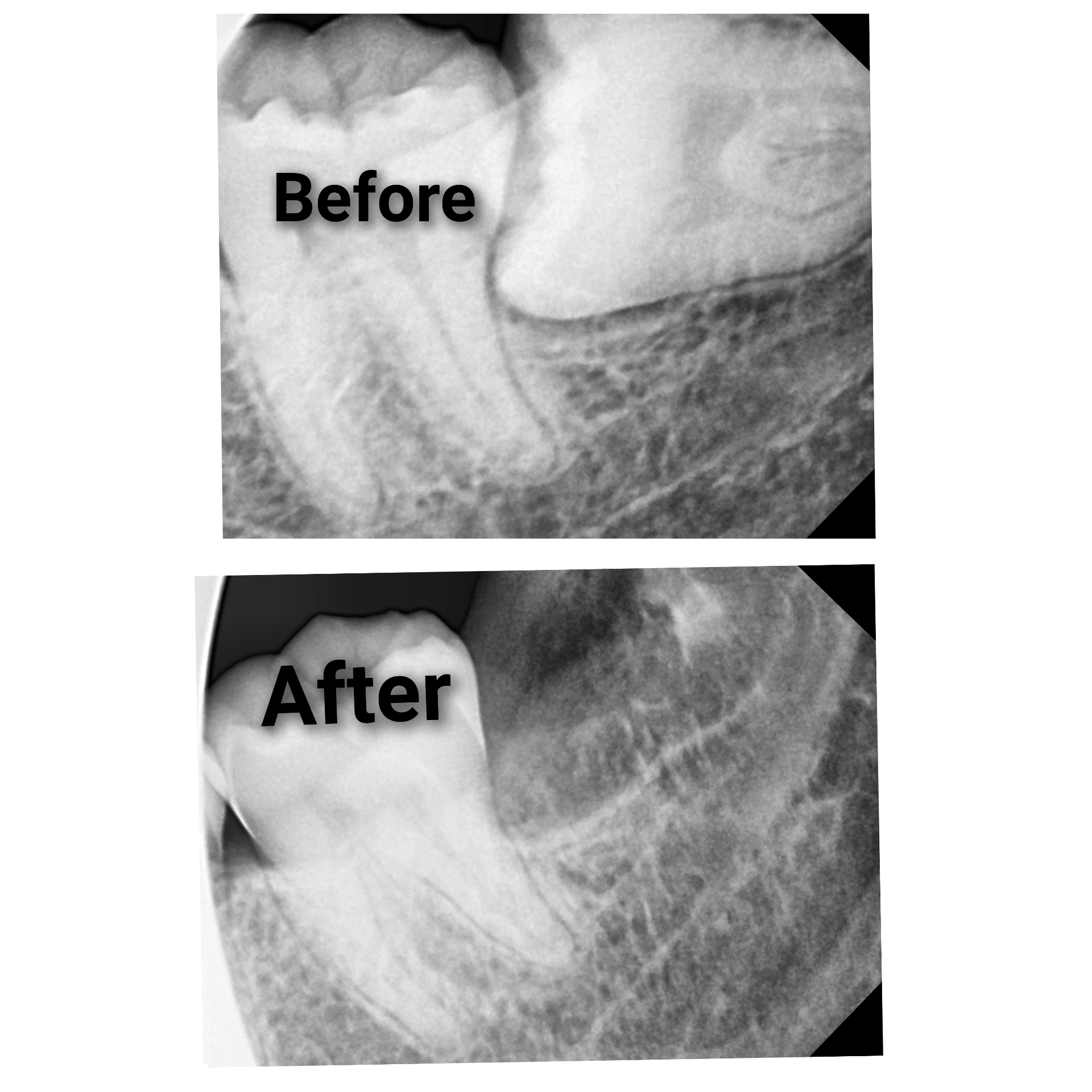Endodontic treatment - Before and After