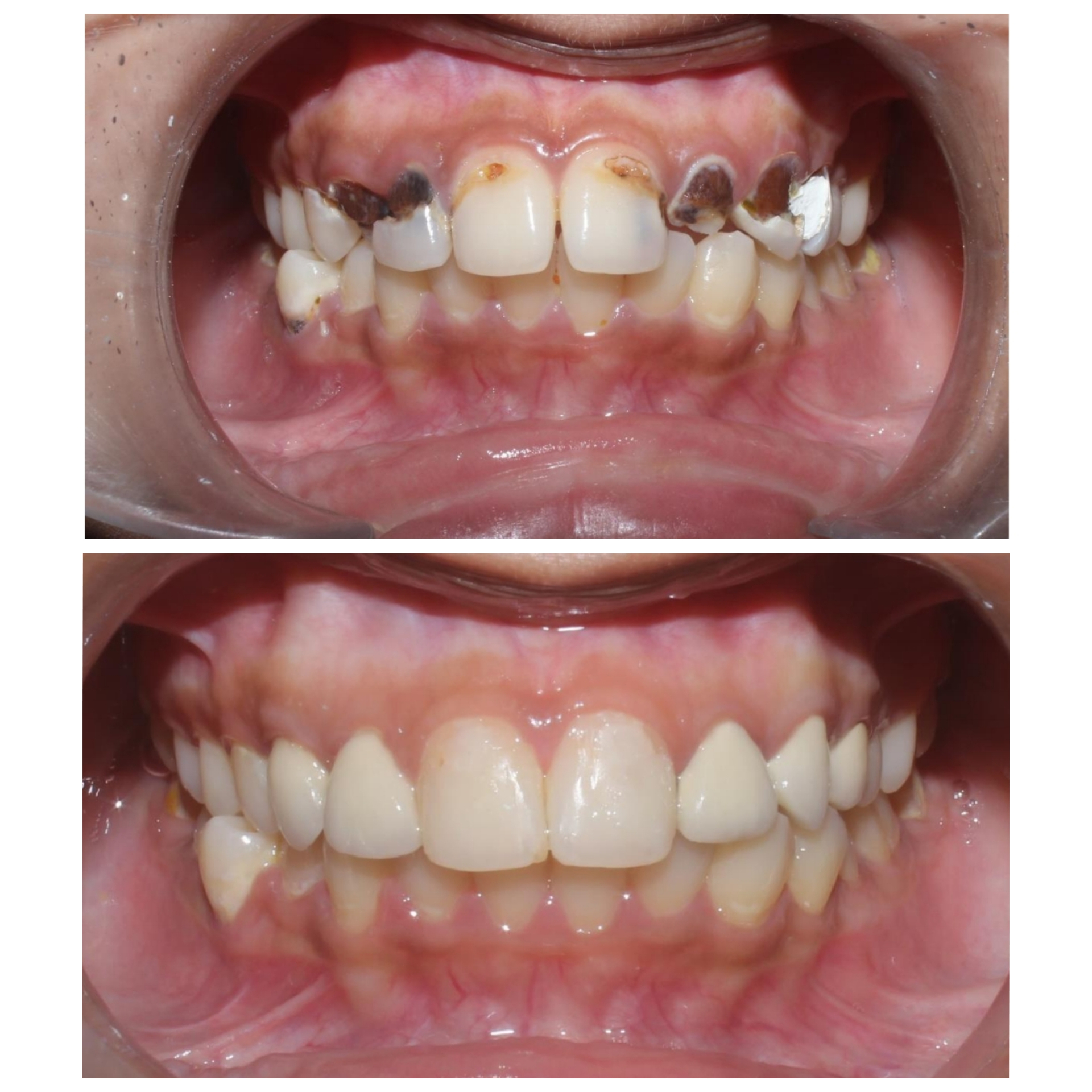 Full mouth rehabilitation - Before and After
