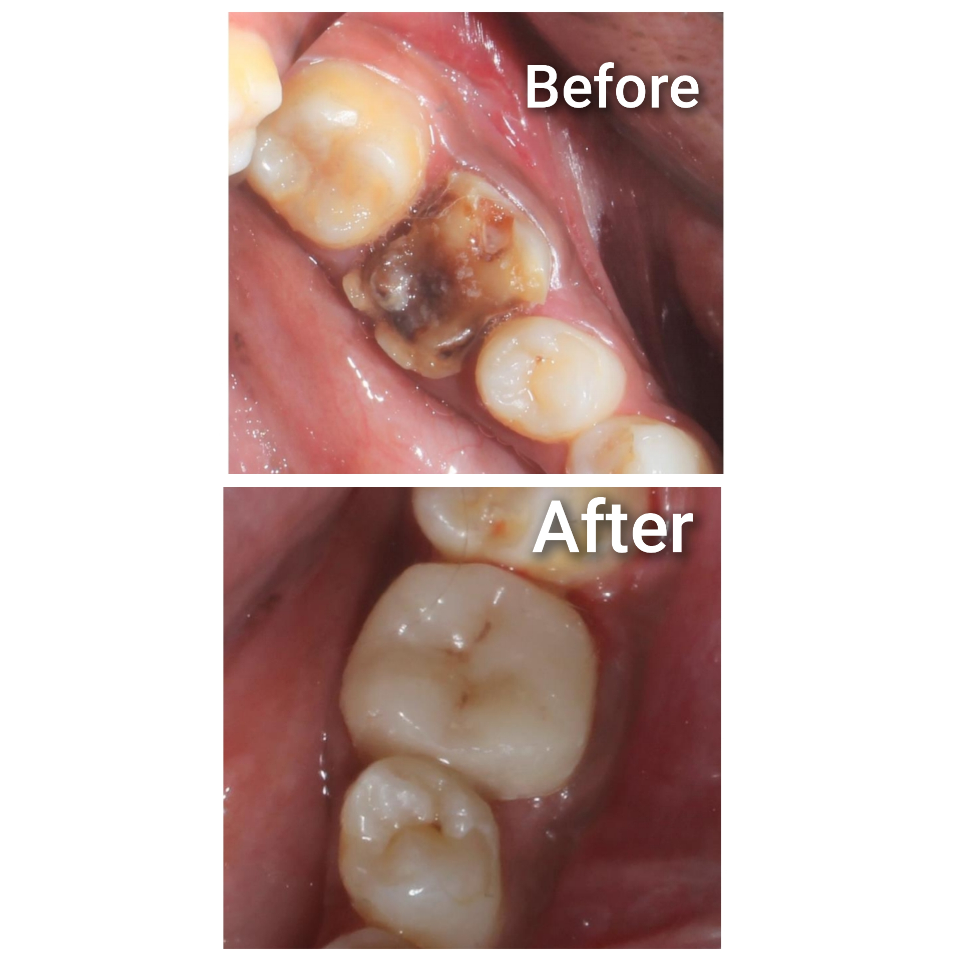 Cavity restoration - Before and After