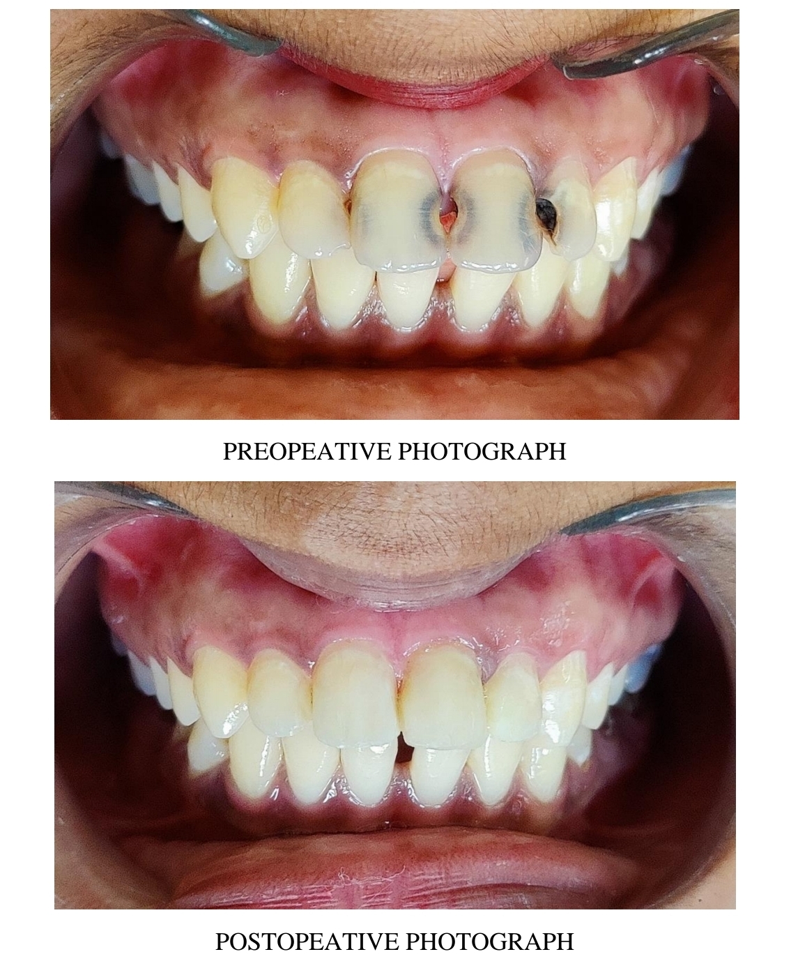 Cosmetic dentistry - Before and After