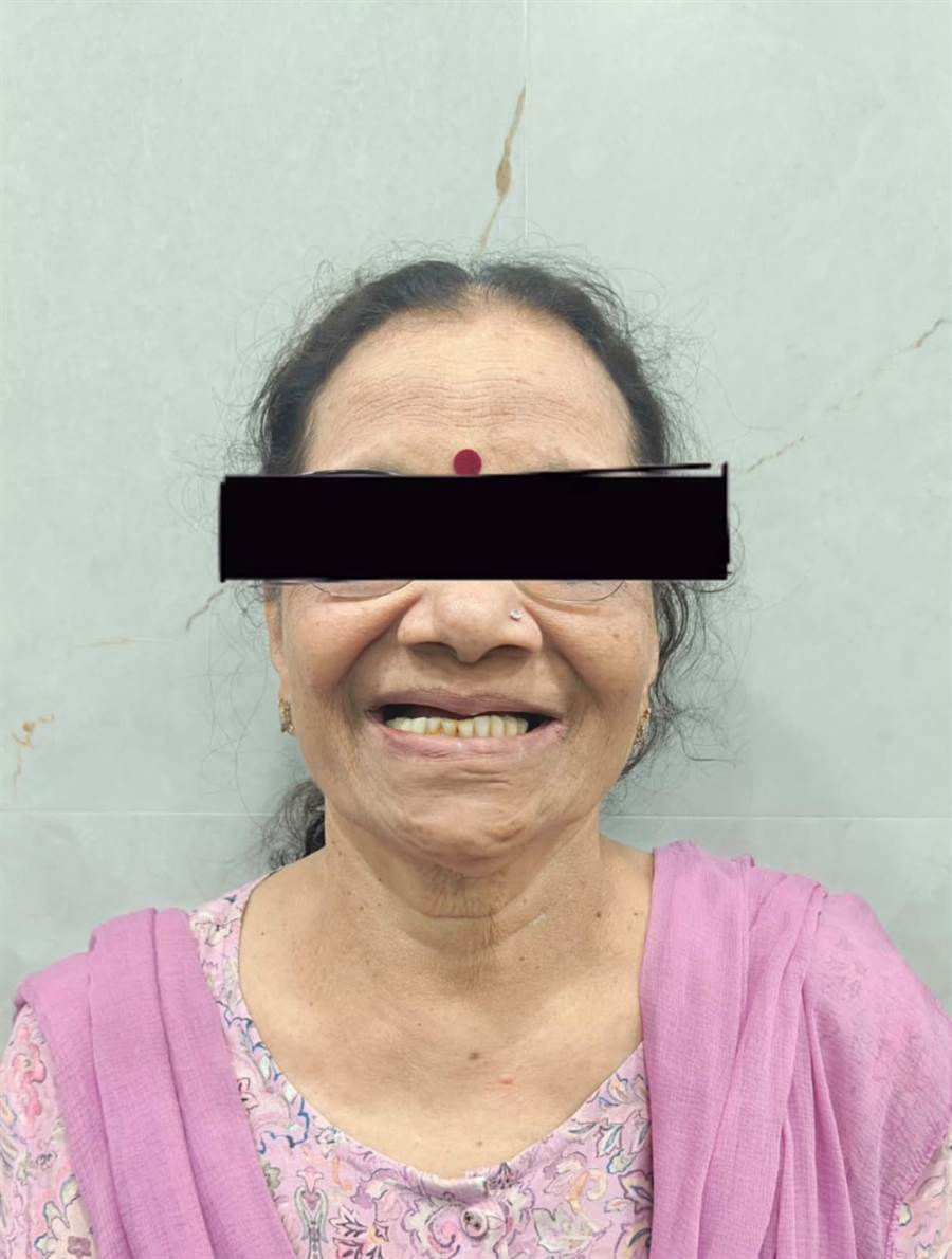 Complete dentures Belapur before treatment — patient with missing and worn natural teeth