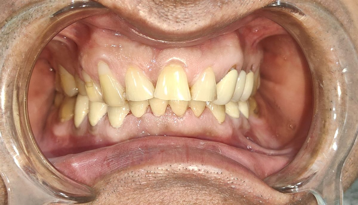 Teeth grinding damage treatment Belapur after photo: lower teeth rebuilt with crowns and gum boils healed