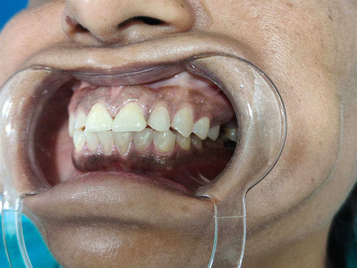 Tooth erosion treatment Belapur after photo: front teeth restored with ceramic crowns after root canal treatment